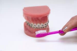 braces