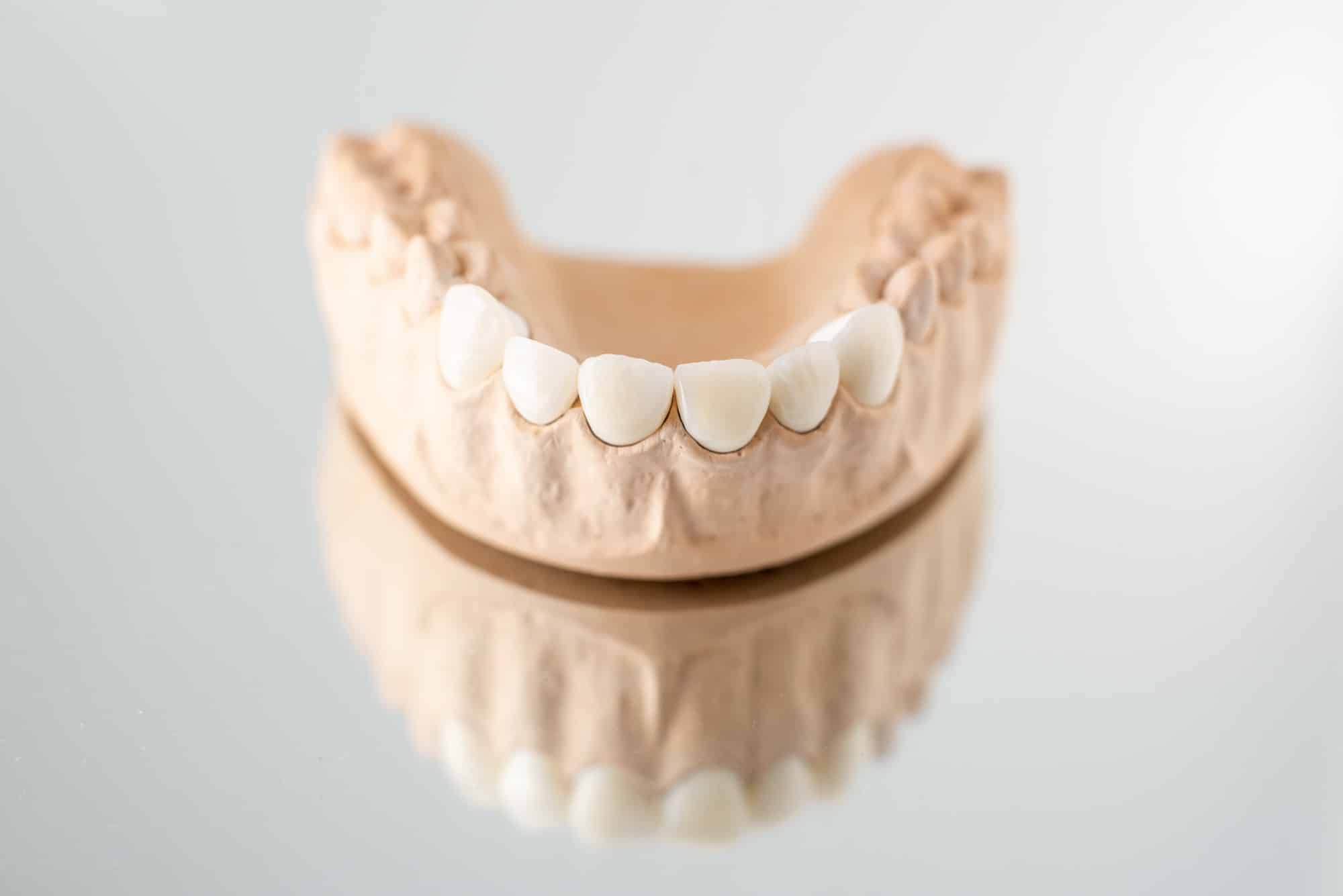 Read more about the article 8 Ways To Make Your Dental Veneers Last