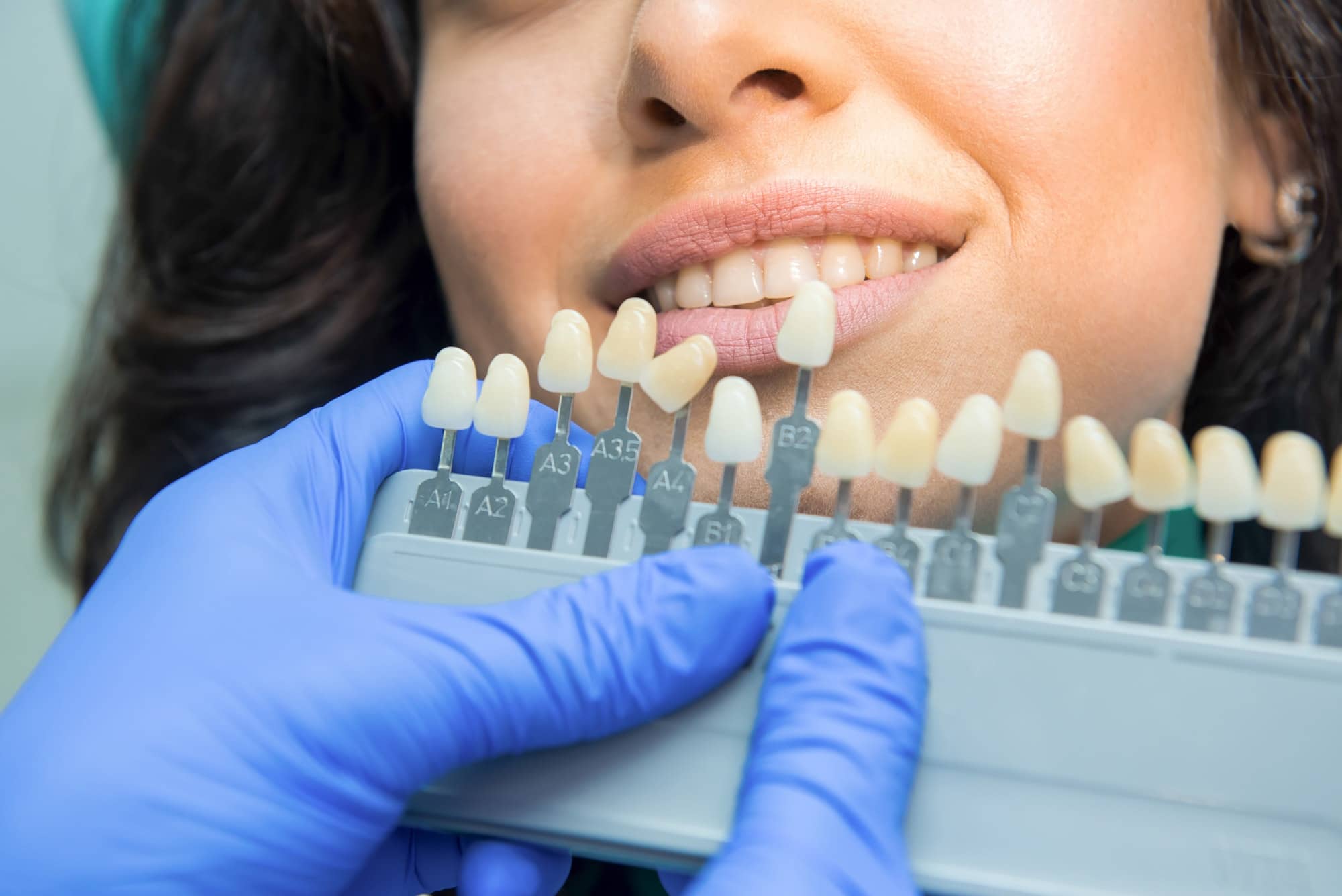 Read more about the article What are the Risks of Teeth Whitening?