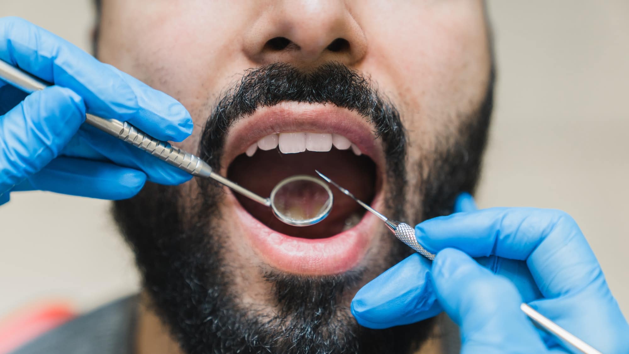 Orthodontist. Opened mouth with healthy white teeth. Veneers and teeth whitening.